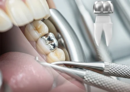 کاربرد آلومینیوم در دندان‌پزشکی و پرکردگی آمالگام